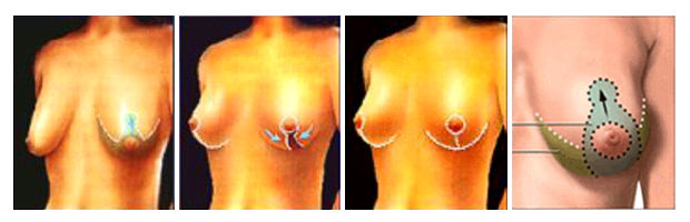 reducción de senos o reducción mamaria